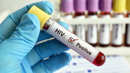 Obraz premium Positive HIV test held by medical professional in blue gloves for healthcare research