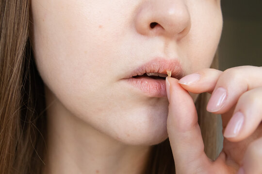 Close-up of woman peeling dry skin from chapped lips. Concept of lip damage, cracked lips and winter skincare.
