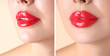 Lip augmentation, collage. Woman showing her lips before and after cosmetic procedure, closeup