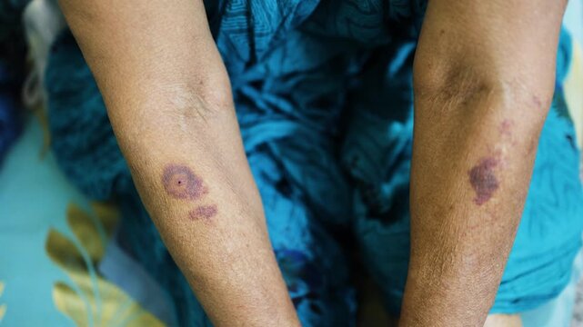 swollen mosquito bite mark causing a red wheal