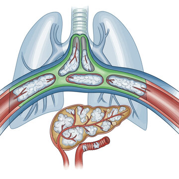 Detailed medical illustration of pulmonary alveoli and pancreatic acini showing pathological changes and cellular structures for scientific research and education
