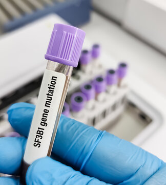 Blood sample for Myelodysplastic SyndromeMyeloproliferative Neoplasm with Ring Sideroblasts and Thrombocytosis (MDSMPN-RS-T) with Cooccurrent SF3B1 and MPL Gene Mutations