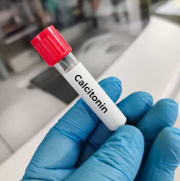 Blood sample for calcitonin hormone test,It acts to reduce blood calcium, opposing the effects of parathyroid hormone (PTH) to diagnosis of Medullary thyroid cancer (MTC) and C-cell hyperplasia.