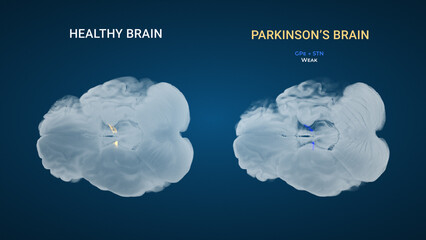 Parkinsons GPe STN Weak Indirect Pathway Comparison