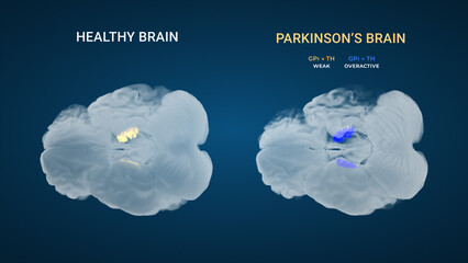 Parkinsons GPi Thalamic Output Imbalance Comparison