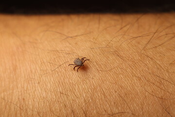 Close-up shot of a parasitic tick crawling on a human hand. A realistic depiction of danger from insect bites and vector-borne diseases, perfect for medical, health, or science projects.