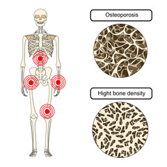 Illustration of osteoporosis, low bone density, spinal compression fracture, risk of fracture. back pain, hip bone. Vector for medical, clinical, or educational posters.