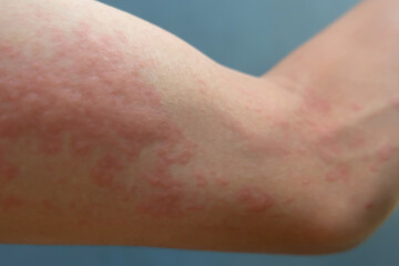Close-Up of Human Hand with Skin Allergy (Urticaria Rash)