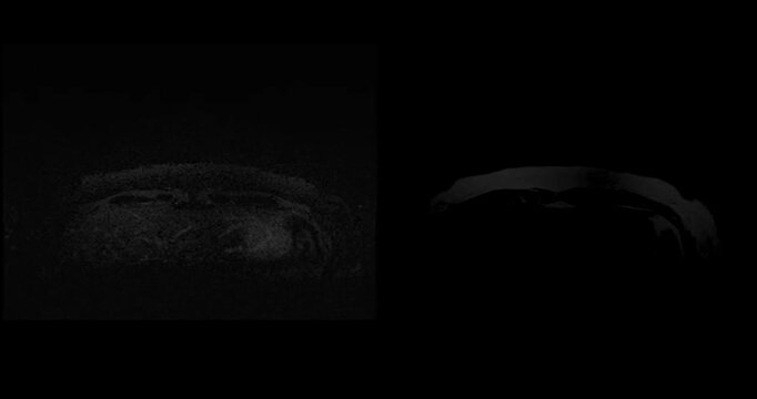 MRI of the breast footage demonstrating a round hypoechoic lesion in the right breast. Advanced radiology imaging for tumor detection and diagnostic evaluation. Low suspicion for malignancy.