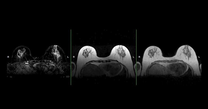 MRI of the breast footage demonstrating a round hypoechoic lesion in the right breast. Advanced radiology imaging for tumor detection and diagnostic evaluation. Low suspicion for malignancy.
