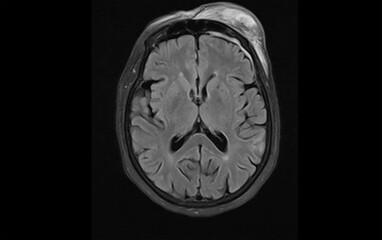 Axial Magnetic Resonance Imaging (MRI) FLAIR Sequence Showing Left Frontal Subdural Hematoma, Traumatic Edema, and Scalp Swelling