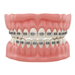 Obraz premium Realistic dental braces model showing upper and lower teeth on transparent background