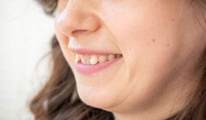 Closeup of young woman smiling with crooked teeth, natural smile, happy expression, imperfect beauty, authentic Female face smiling, , happy expression