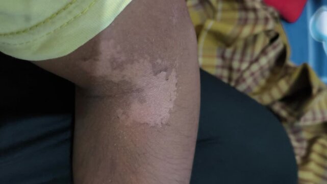 peeling skin and spots due to sunburn starting with water blisters