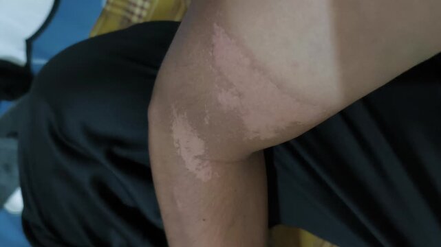 peeling skin and spots due to sunburn starting with water blisters