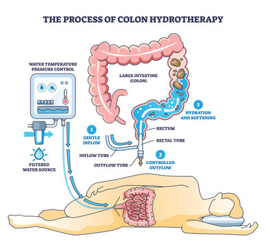 Colon hydrotherapy process diagram shows gentle inflow, hydration, and controlled outflow, key objects, colon, rectal tube, water control unit. Outline diagram