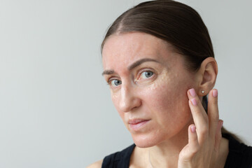 Pain after beauty injections. Woman has face pain after biorevitalization