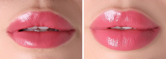 Lip augmentation, collage. Woman showing her lips before and after cosmetic procedure, closeup