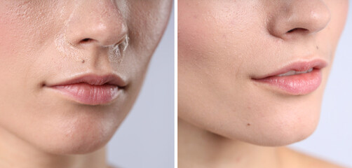Obraz premium Woman with dry skin on face before and after moisturizing treatment, closeup. Collage of photos