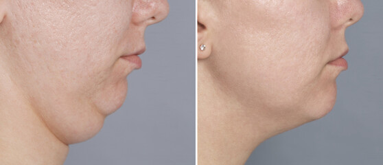 Woman with double chin before and after surgery, closeup. Collage of photos on grey background