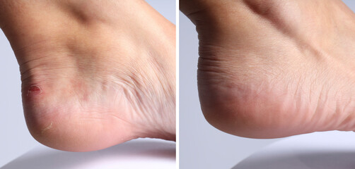 Fototapeta premium Woman with dry skin on heel before and after moisturizing treatment, closeup. Collage of photos