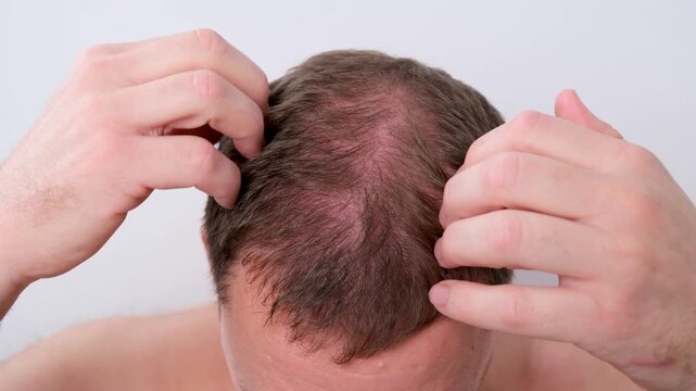 Top view of young man examining his scalp, concerned about hair thinning and premature baldness isolated on a white background. This illustrates concepts of alopecia and hair care treatment