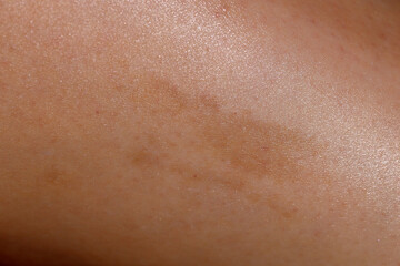 Fototapeta premium Macro close-up of a woman’s skin with a visible pigmentation spot.