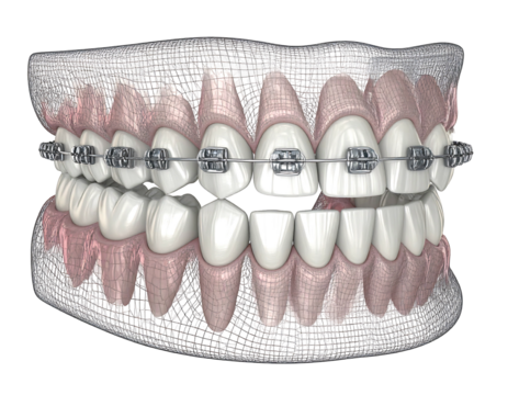 Rendered teeth with braces, showing gums, wireframe design, and a black background
