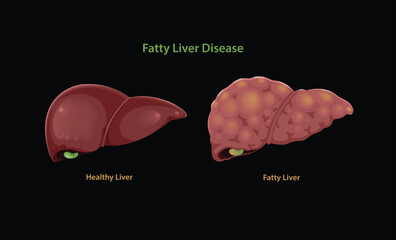 Illustration of Human Healthy Liver and Gallbladder and Fatty Liver Disease