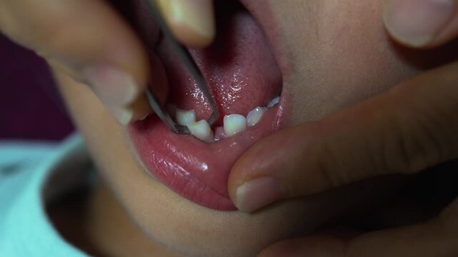 Primary Tooth in Child will soon fall out for Dental Health Education 1