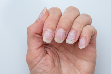Damaged natural fingernails after gel polish removal on human hand close-up. A natural hand with problematic cuticles and broken nails. Emotional stress. Age-related skin changes. Hand care