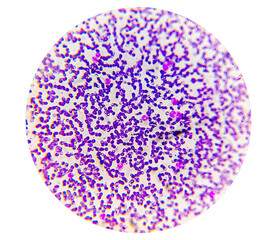 Leukemia cells, Neutrophil , Lymphocyte in blood smear.