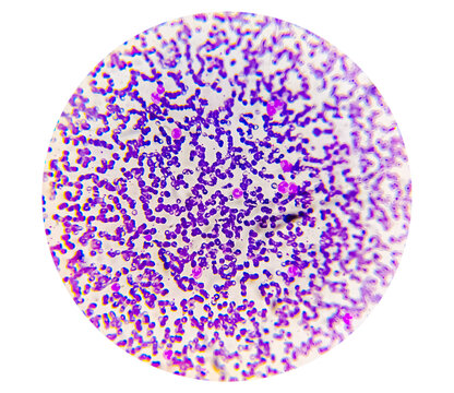 Leukemia cells, Neutrophil , Lymphocyte in blood smear.