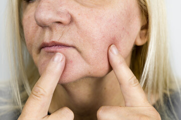 Fototapeta premium Mature woman is pointing on wrinkles around eye. Plastic surgery concept