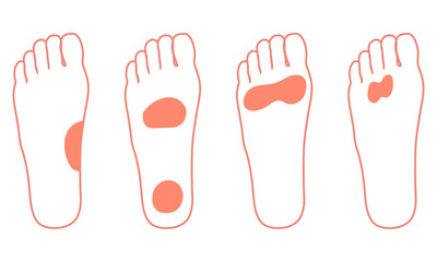 足裏の痛み　炎症が起きる箇所