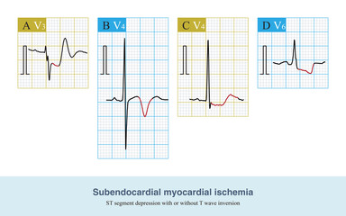 During subendocardial myocardial ischemia, ischemia is confined to subendocardial myocardium, and the main changes of ECG are ST segment depression and T wave inversion.
