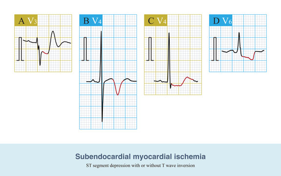 Ischemia Images – Browse 8,430 Stock Photos, Vectors, and Video | Adobe ...