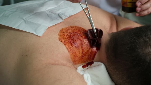 Medical staff carefully disinfecting a patient's skin on the shoulder with povidone-iodine, preparing the surgical site for an atheroma removal procedure in an operating room