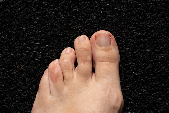 Yellow nail syndrome. Toenails. After treatment.