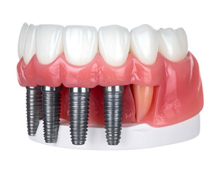 A close up of a denture model with titanium implants protruding from the gum line, against a solid black background