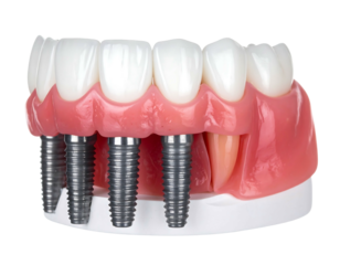 A close up of a denture model with titanium implants protruding from the gum line, against a solid black background