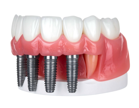 A close up of a denture model with titanium implants protruding from the gum line, against a solid black background