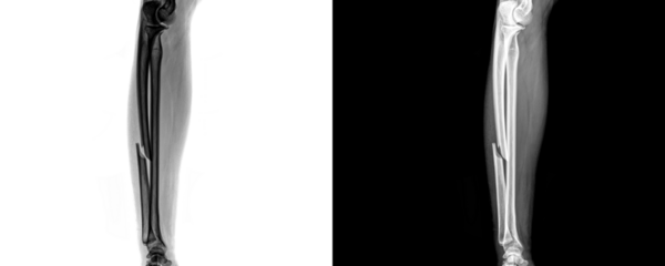 Lateral View Forearm X-Ray Showing Radius, Ulna, and Skeletal Anatomy for Fracture Diagnosis