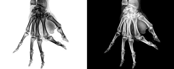 Lateral View Hand X-Ray Radiograph Showing Skeletal Anatomy and Bone Alignment for Educational Use