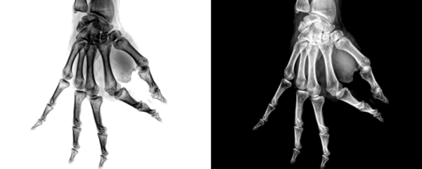 Lateral View Hand X-Ray Radiograph Showing Skeletal Anatomy and Bone Alignment for Educational Use