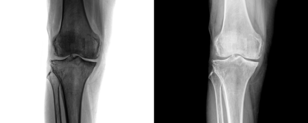 Human Knee Joint X-Ray in Anterior View Depicting Bone Structure and Joint Alignment for Arthritis
