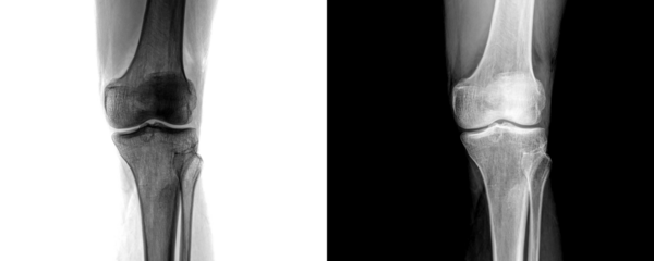 Knee Joint Anterior X-Ray View Demonstrating Skeletal Framework and Bone Anatomy for Arthritis