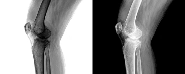 X-Ray of Human Knee Joint in Lateral View Depicting Bone Structure and Joint Alignment for Arthritis