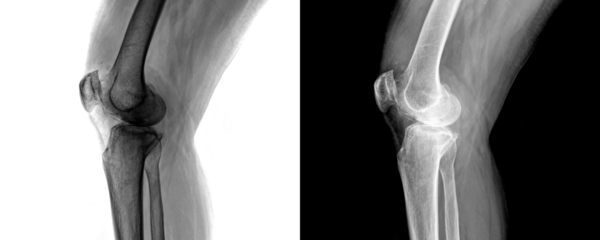 X-Ray of Human Knee Joint in Lateral View Depicting Bone Structure and Joint Alignment for Arthritis