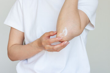 Young  woman in white tshirt experiencing pain from arthritis, elbow injury, applying a therapeutic cream to the elbow joint. Joint diseases. Woman applying cream on the dry skin on the elbows